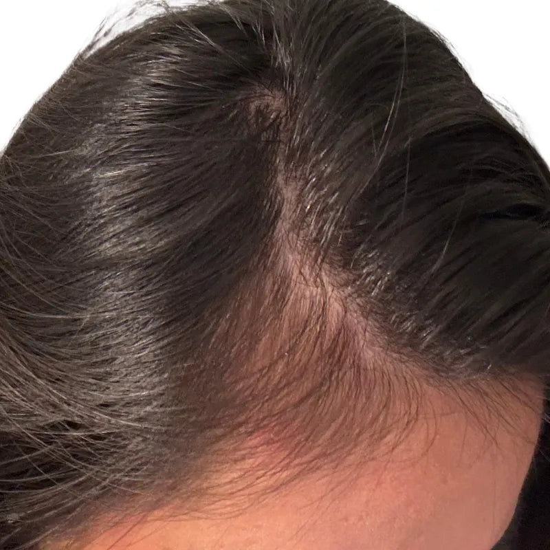 Hairline, after twelve months of use